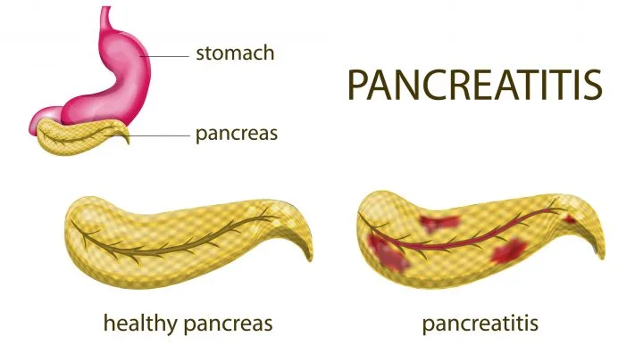 illustration of the gaster, pancreas and pancreatitis